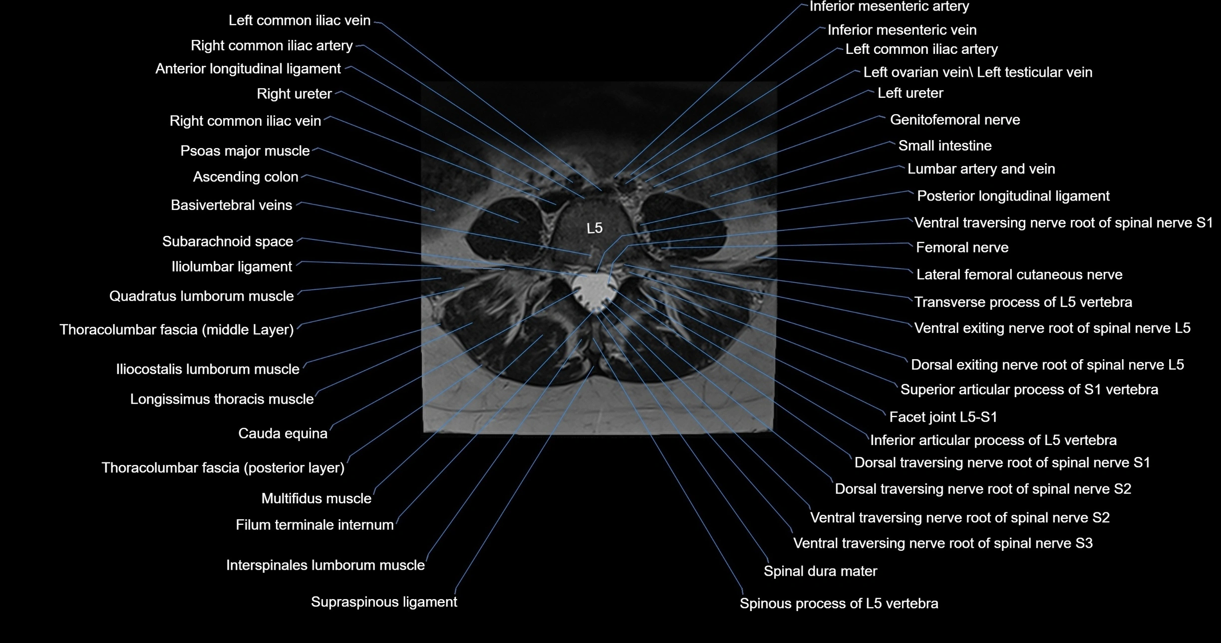 MRI lumbar spine axial cross sectional anatomy 3T radiology  image-img-00001-00038.webp